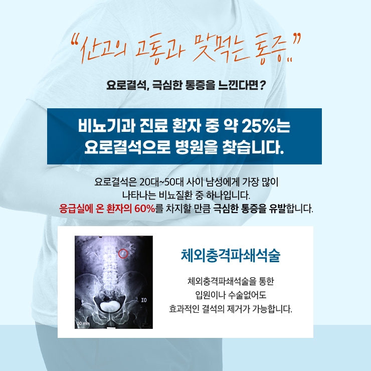 요로결석 치료 이미지